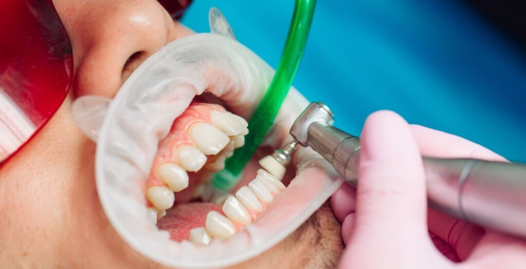 5 Surpri****g Benefits of Regular Teeth Cleaning in Marietta - Posts Content