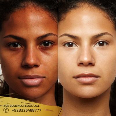 Best Skin W****ening Injection in Islama****, Pakistan