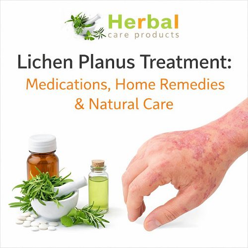Lichen Pl**** Treatment: Medications, Home Reme****s & Natural Care